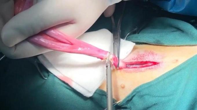 সম্পর্কে সর্বশেষ কোম্পানী কেস ক্যাট স্পে এবং নিউটার সার্জারিতে পোষা অতিস্বনক স্ক্যাল্পেল ব্যবহার করে | Surgsci 0