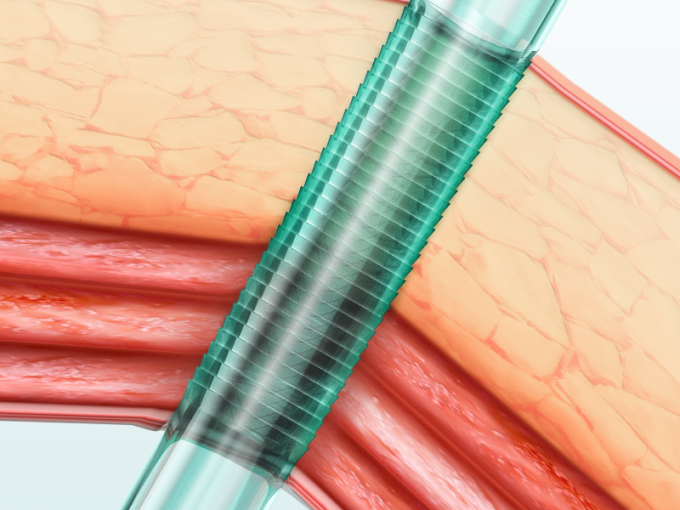 সর্বশেষ কোম্পানির খবর ইজিপাস ব্লেডলেস ডিসপোজেবল ল্যাপারোস্কোপিক ট্রোকারের বৈশিষ্ট্য ও সুবিধা | সার্জসি  0