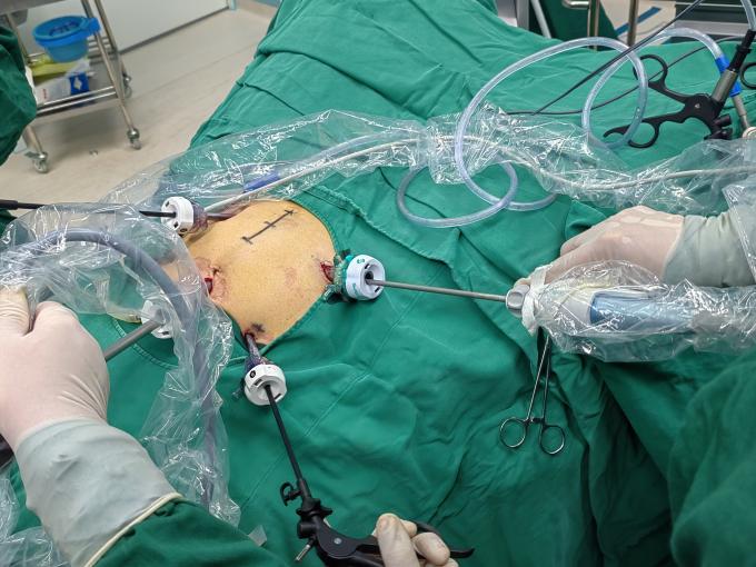 সম্পর্কে সর্বশেষ কোম্পানী কেস SurgSci Laparoscopic Trocar এবং অতিস্বনক স্ক্যাল্পেল ব্যবহার কেস | Surgsci  1