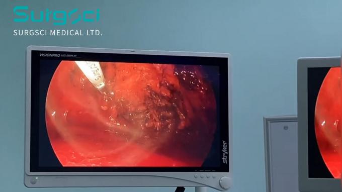 সম্পর্কে সর্বশেষ কোম্পানী কেস SurgSci অতিস্বনক স্ক্যাল্পেল ব্যবহারে | হার্নিয়া মেরামত | Surgsci  0