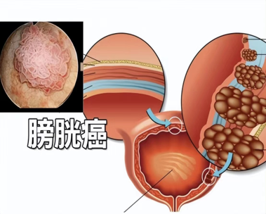 সর্বশেষ কোম্পানির খবর ক্লিনিক্যাল ডায়াগনসিস এবং ব্যায়ামগত যত্ন ব্যায়াম ক্যান্সারের।  0